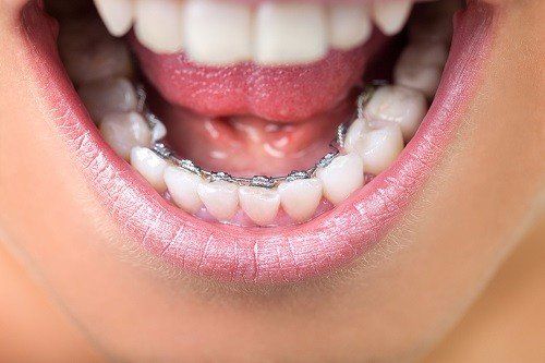 braces, dental care